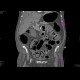 Bowel ischemia, gas in portal vein and liver: CT - Computed tomography